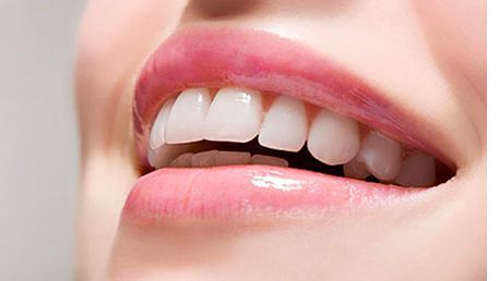 price of veneers