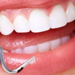 Are Veneers Permanent? Things to Know