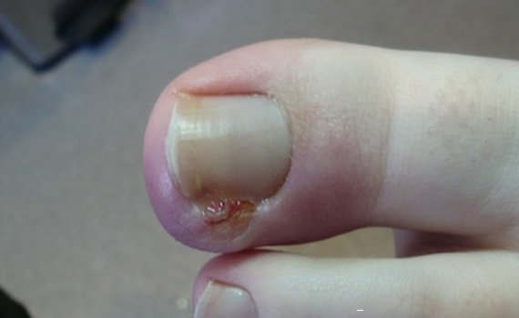 toenail implant